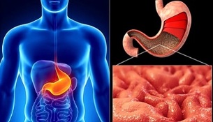 dietary rules for gastritis